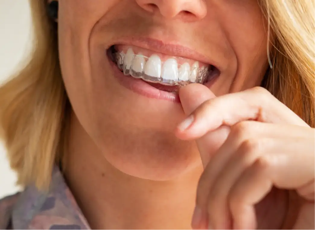INVISALIGN CLEAR ALIGNERS